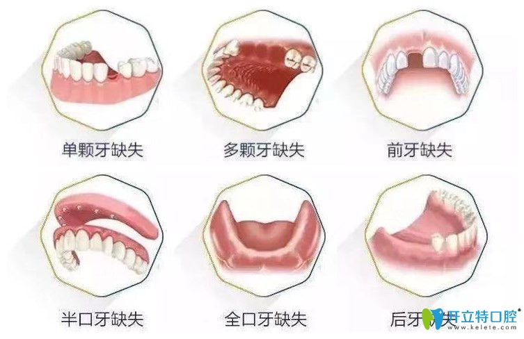 石家庄中诺口腔种植牙征集人群