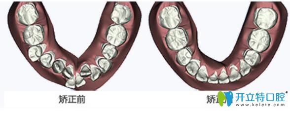 舌侧矫正前后