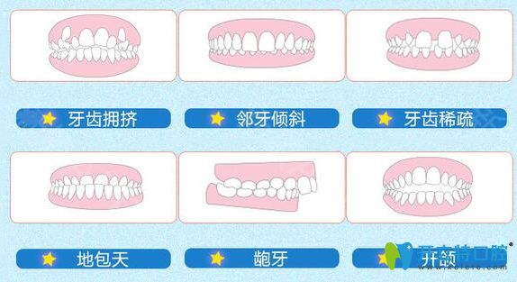 需要做牙齿矫正的一些图片