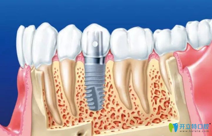 即刻种植牙与传统种植牙的区别
