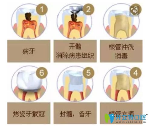 根管治疗过程图示