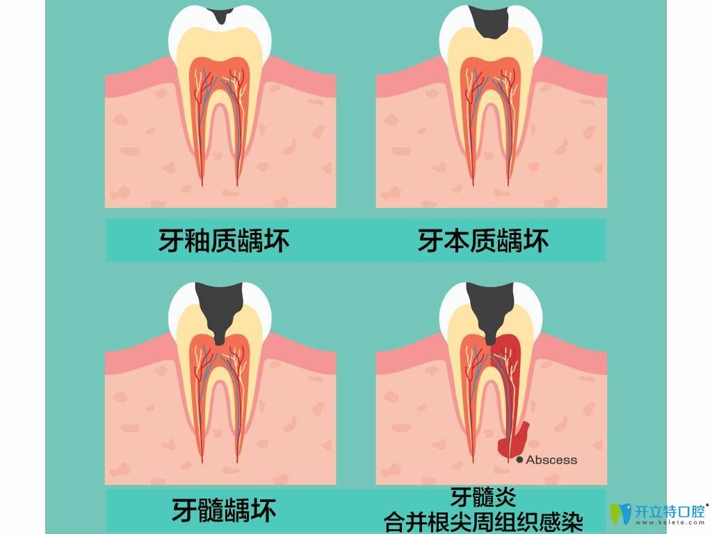 龋齿发展过程