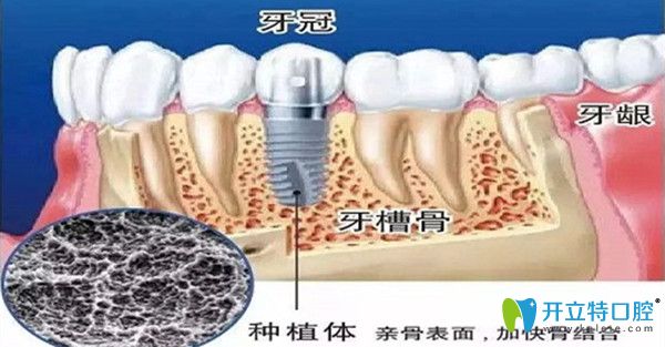 种植牙要如何护理才能用的更久