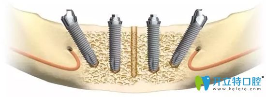All-on-4半口种植修复技术示意图