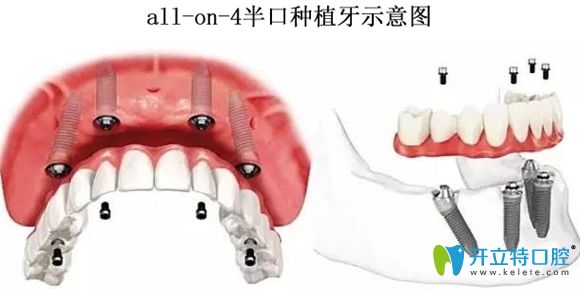 all-on-4半口种植牙示意图