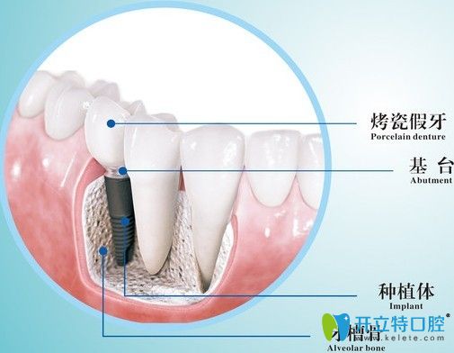 石家庄种植牙收费价格表