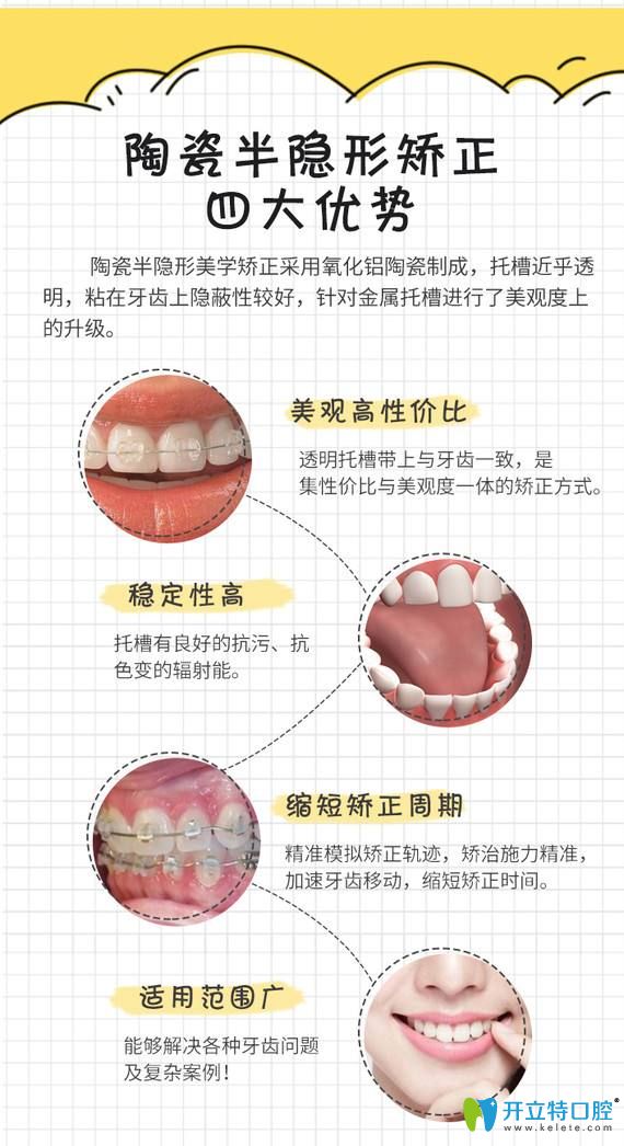 陶瓷半隐形矫正优势图