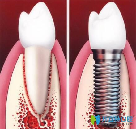 种植牙图片