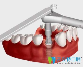 宁波恒美口腔王敬彬即刻负重种植牙好处