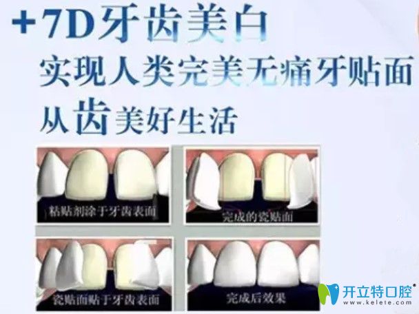 黄仁辉医生告诉你7D牙齿美白技术是什么