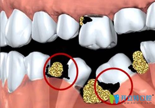 缺一颗牙会有什么影响?武汉仁爱口腔用视频展示缺牙的危害