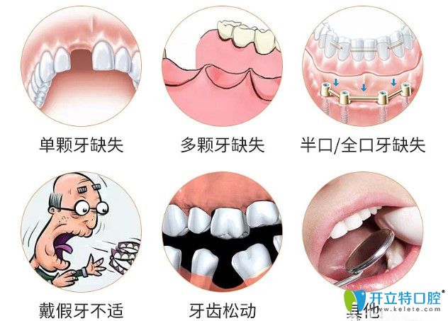 种植牙价格跟个人口腔情况息息相关的