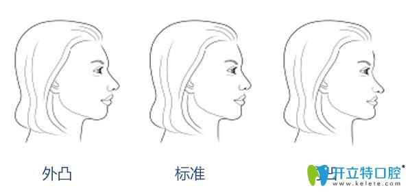 牙齿畸形不同程度对比图