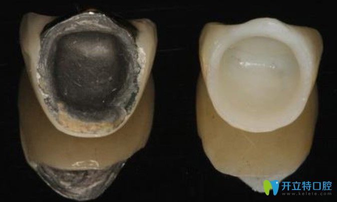 祁凯医生解析全瓷牙和烤瓷牙哪个好