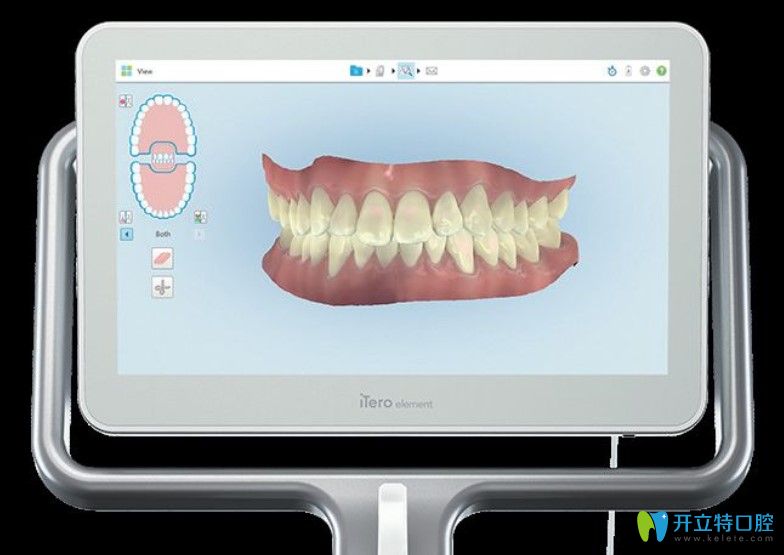 隐适美iTero口和传统取模相比具体优势