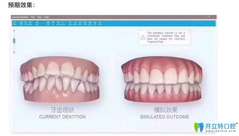 itero口内可让顾客提前预知矫正效果