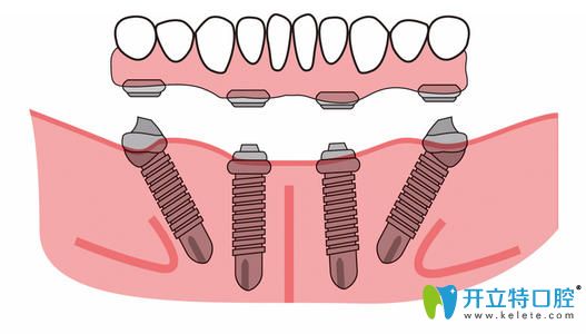 all-on-4速导种植牙技术