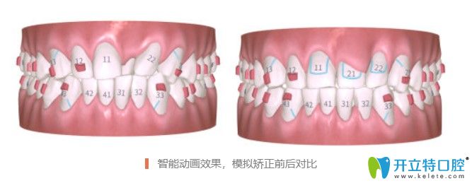 仁爱口腔有iTreo口扫仪