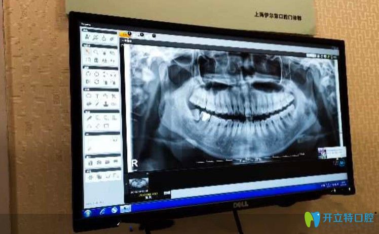 在<!--<i data=20240703-sp></i>-->伊尔意检查牙齿时候拍的牙片