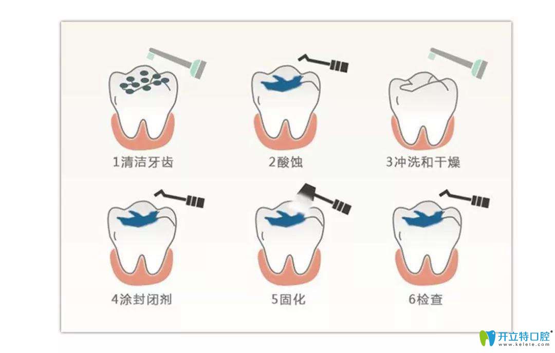 窝沟封闭步骤图示