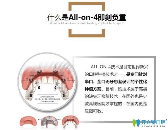 牙博士all-on-4/6即刻负重种植牙介绍