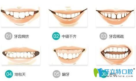 需要做牙齿矫正几种类型图