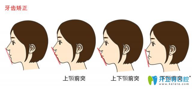 需要做牙齿矫正几种脸型图