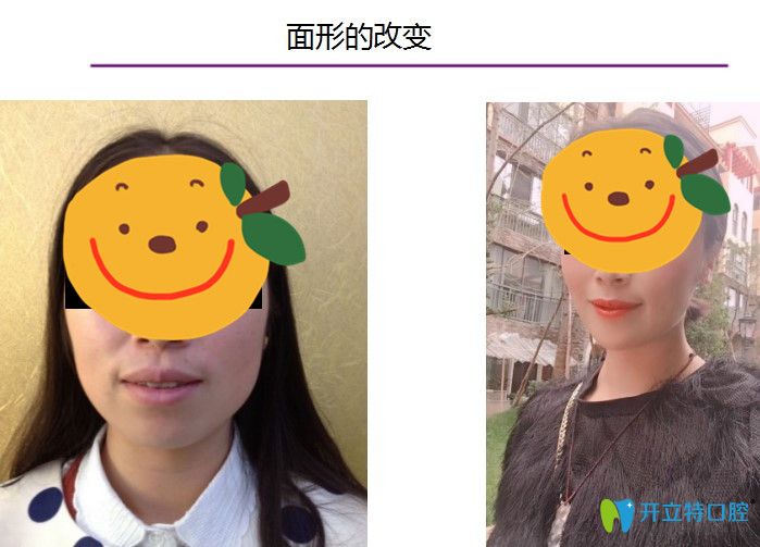 哇哦我在昆明長鵬口腔矯正齙牙後臉型變化很大嘴唇也薄了