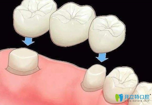修大夫口腔苏明坤医生解析：固定义齿修复有哪些优缺点