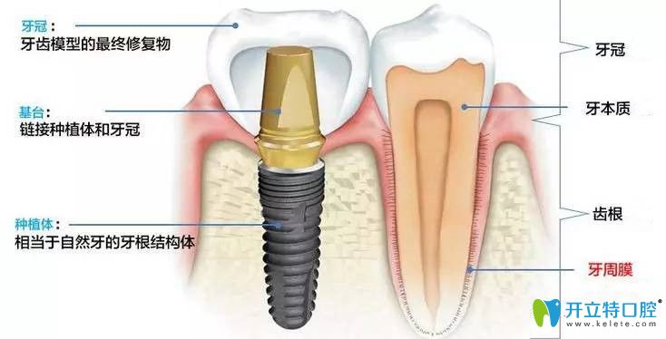 种植牙构造分布图