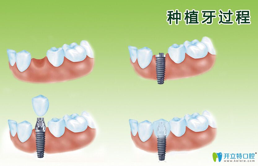 种植牙过程图示