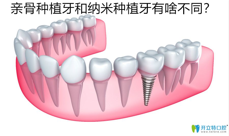 亲骨种植牙和纳米种植牙不同之处有啥