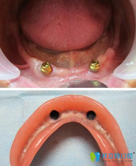 ⑤磁性附着体式覆盖义齿磁铁的吸力使义齿就位于衔铁上种植覆盖义齿