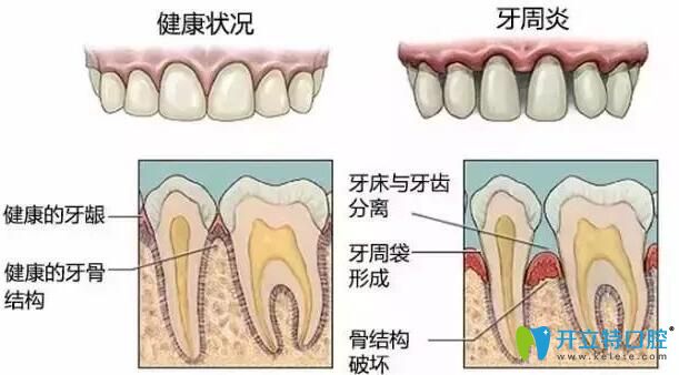 牙周炎