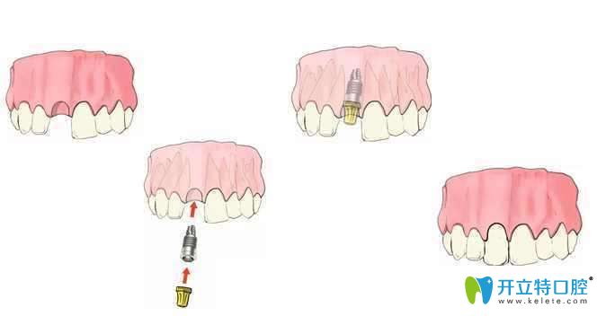 种植牙过程