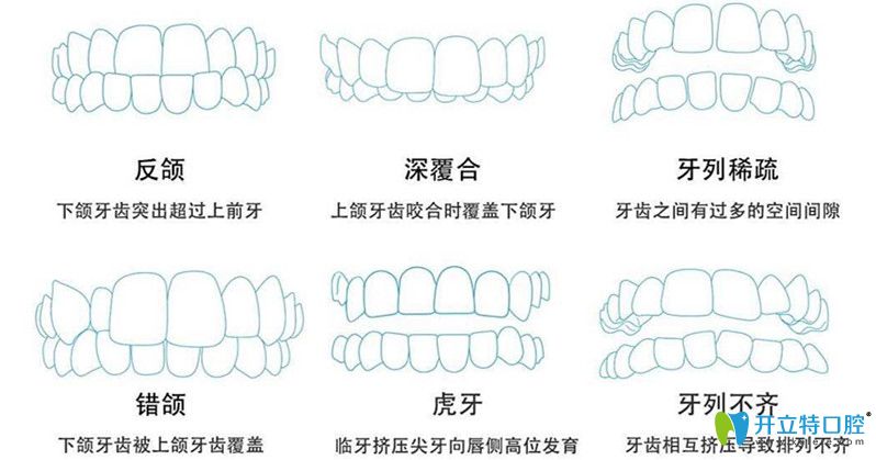 6大牙齿问题需要做矫正