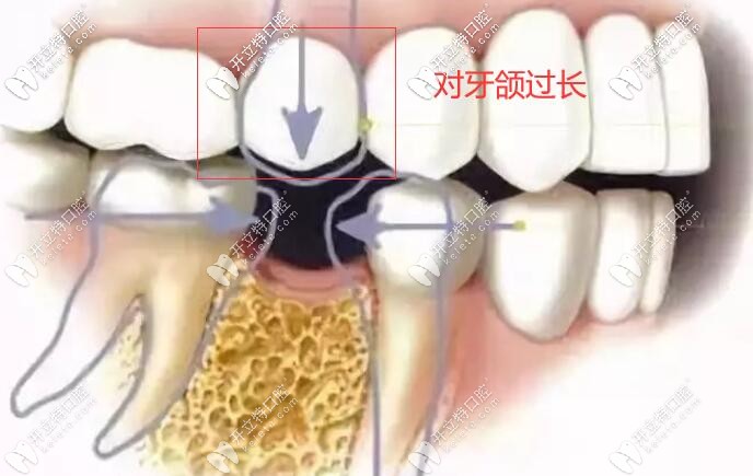 对面牙齿过长,上下咬合空间不够怎么做种植牙?