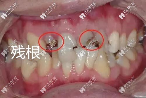 牙冠牙根牙颈图片图片