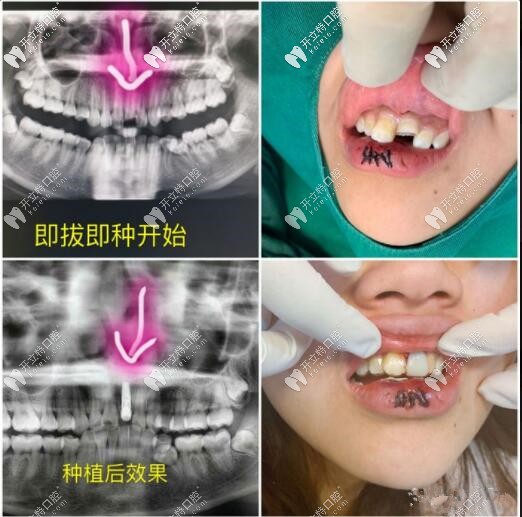 门牙磕断不能保留，即拔即种种植牙当天就能拥有好牙