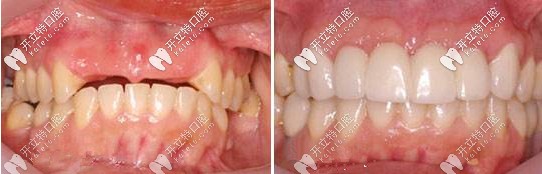 种植牙前后对比图