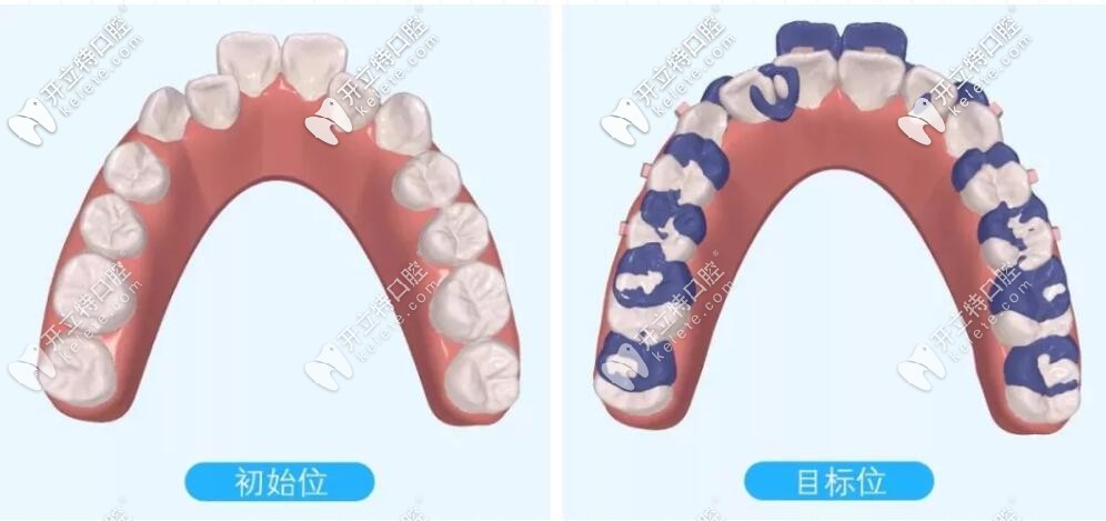 磨牙后推示意图