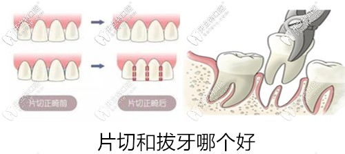 片切和拔牙哪个好