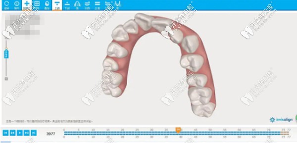 隐适美牙齿矫正动画图