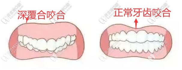 打开深覆合咬合,平导和支抗钉哪个效果好？超详细分析