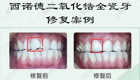 西诺德二氧化锆全瓷牙修复门牙案例