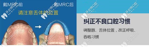 儿童正畸选mrc矫正器和前方牵引器哪个效果更好