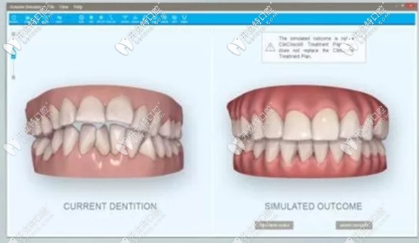 采用隐形矫正术前就可预见矫正效果
