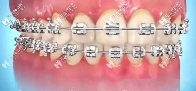 刚戴牙套牙齿样子