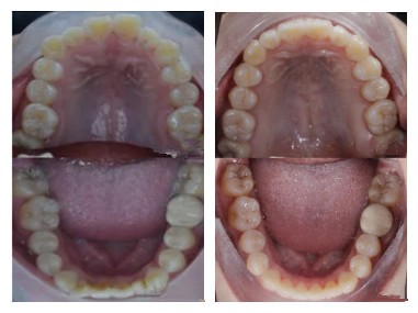 正常人的口腔两侧图片图片