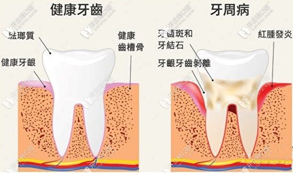 牙周疾病是可防可控的